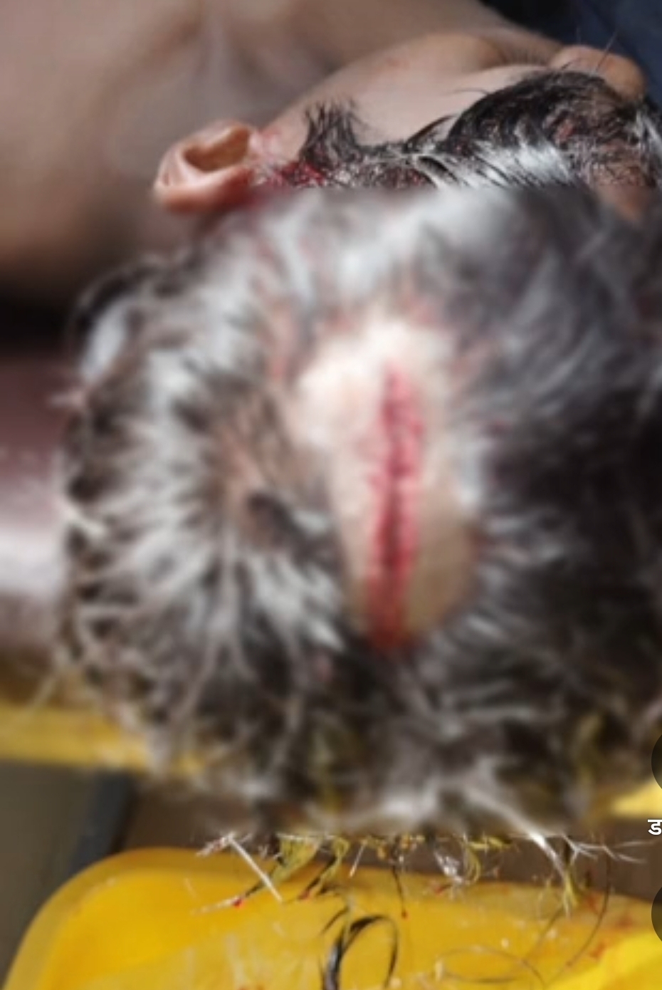 कोरबा में राज्य स्तरीय खेल प्रतियोगिता के बाद बवाल, ट्रॉफी विवाद में खिलाड़ी पर हॉकी स्टिक से हमला — सिर पर लगे 14 टांके